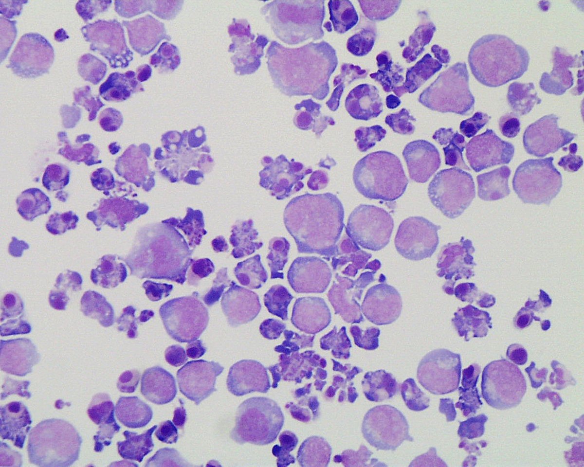 Apoptotic leukemic cells